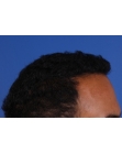 After Hair Transplant&nbsp;Front